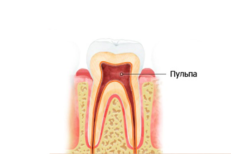 Как выглядит пульпа зуба фото