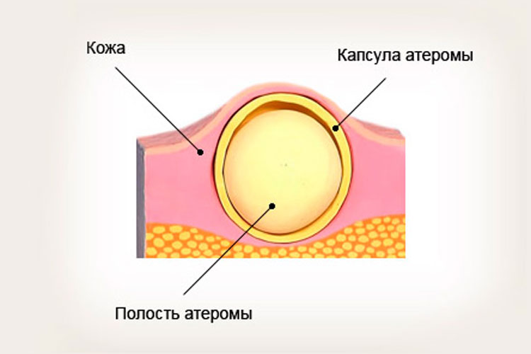 Атерома как выглядит фото