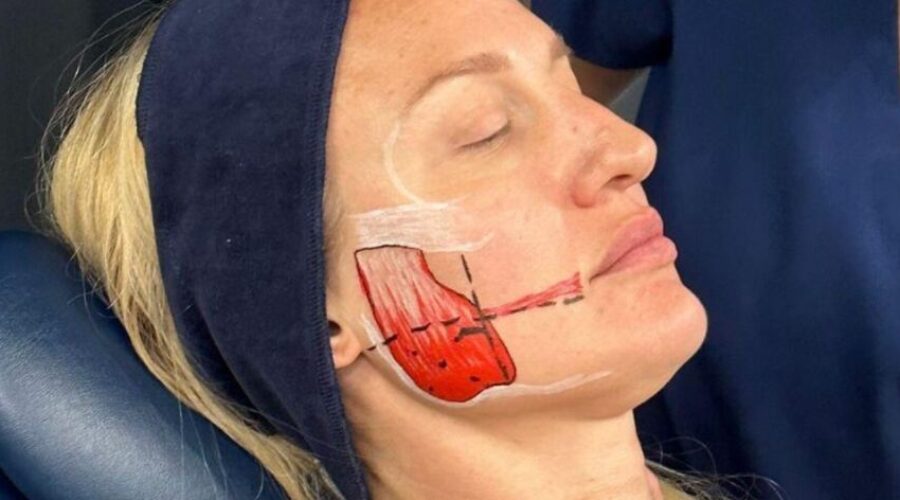 Ботокс у жувальні м’язи в Києві: ефективне рішення для здоров’я та естетики у косметолога Філіппа Кравченка