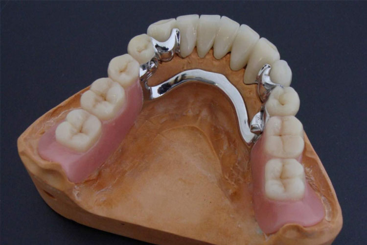 Бюгельні протези - Dentist-Club