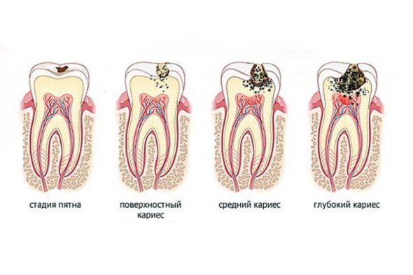 Что такое кариес и как с ним бороться?