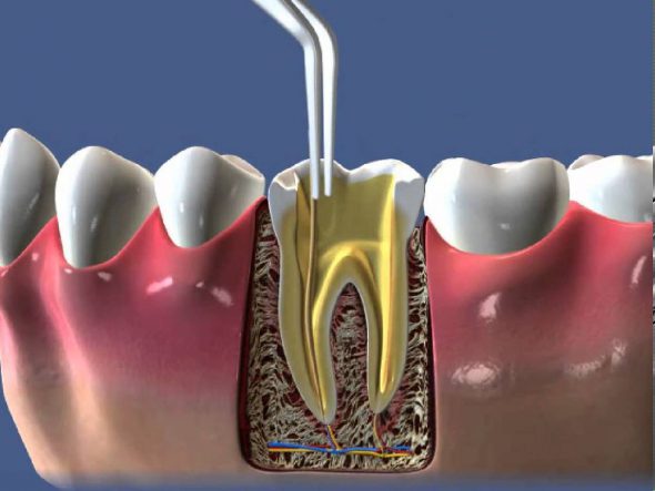 Эндодонтическое лечение зубов