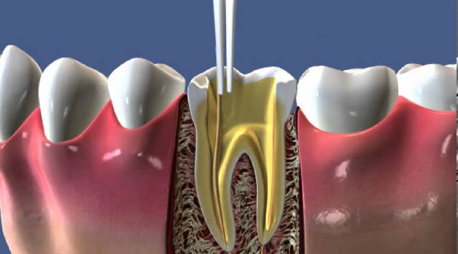 Ендодонтичне лікування зубів