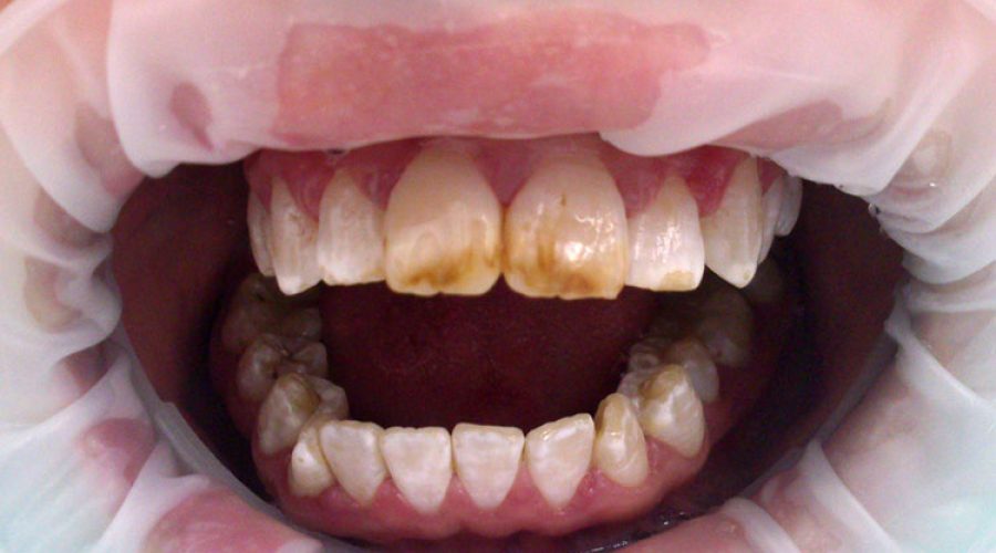 Флюороз зубів: причини, форми та лікування