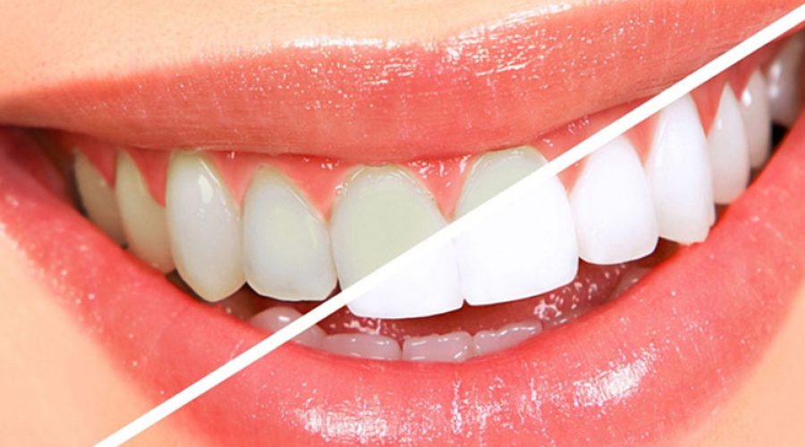 Гигиеническая чистка зубов