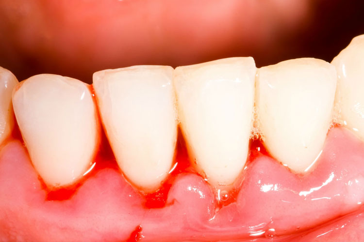Гингивит - Dentist-Club