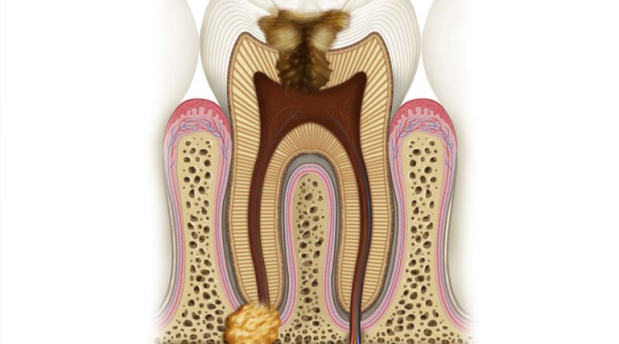Гранулема зуба