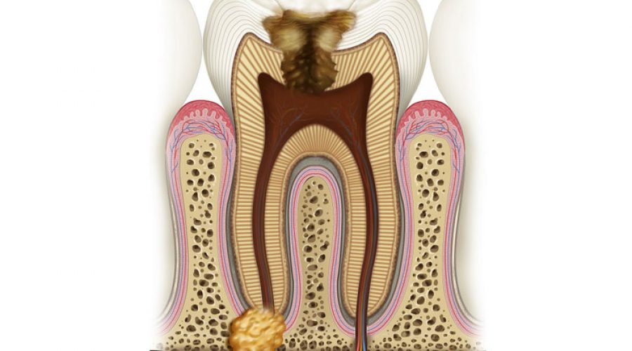 Гранульома зуба