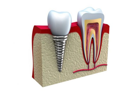 История зубных имплантатов