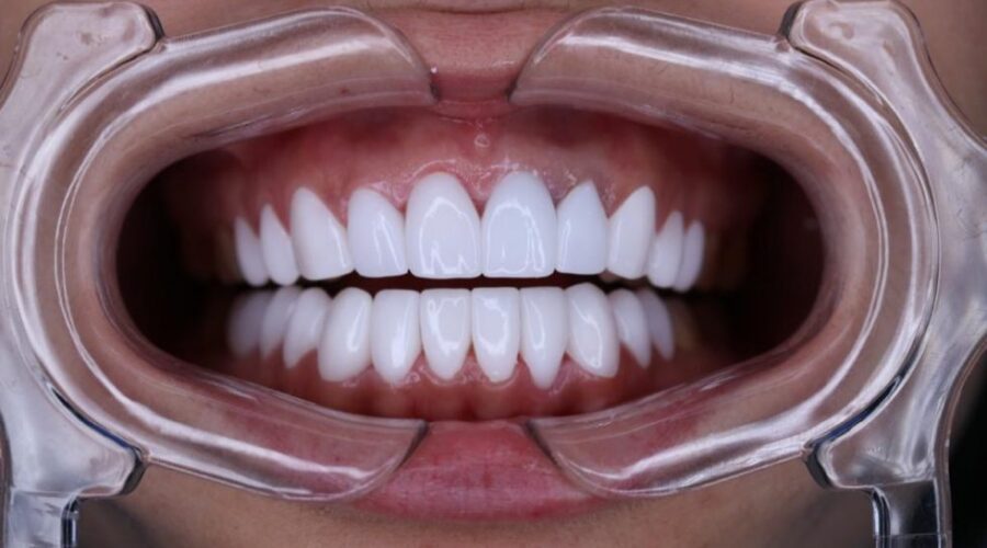 Керамические зубные виниры — лучшее решение для безупречной улыбки