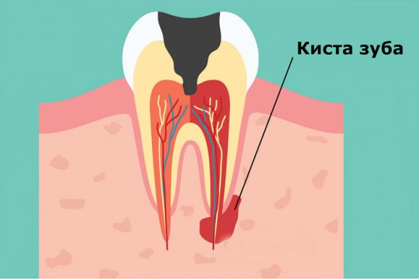 Киста зуба. Что это такое?