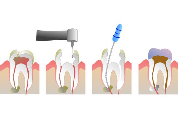 Лечение зубных каналов