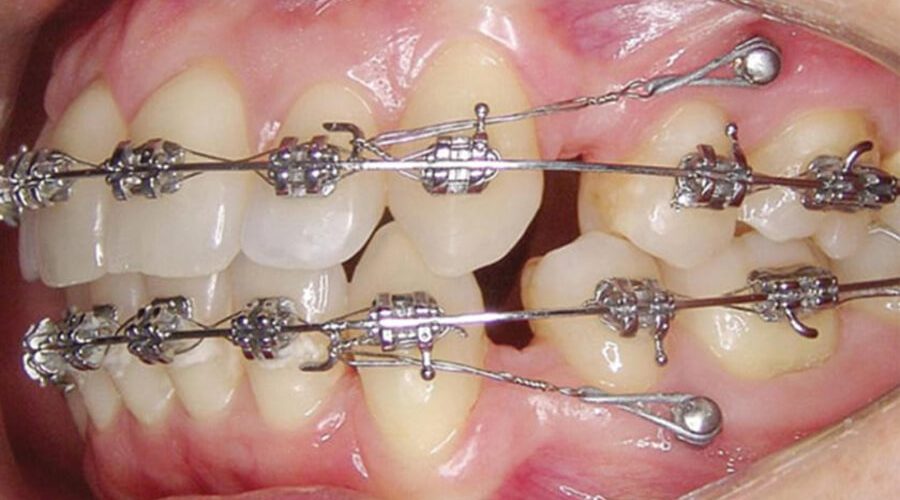 Минивинты или микроимпланты в ортодонтии