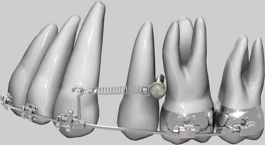мини импланты в ортодонтии