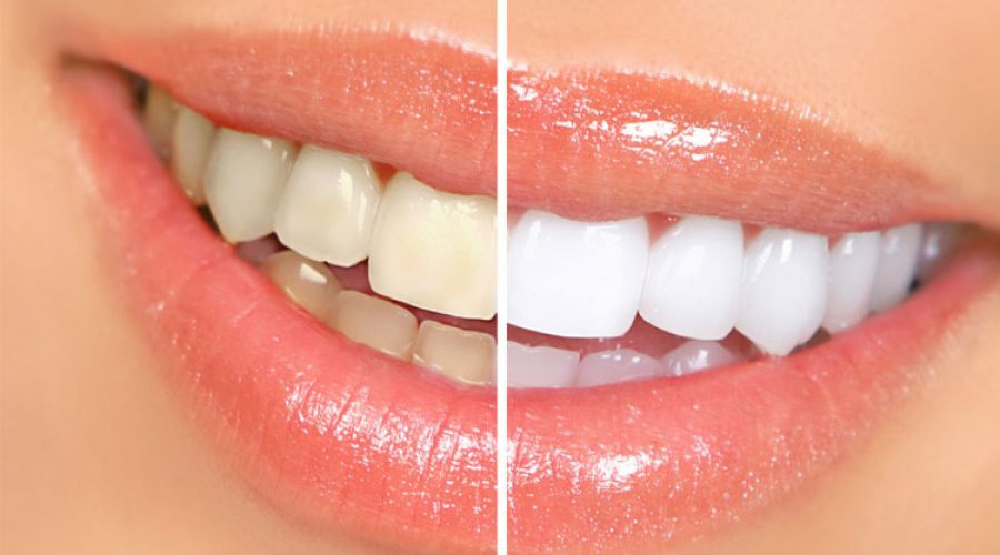 Відбілювання зубів: «за» і «проти»