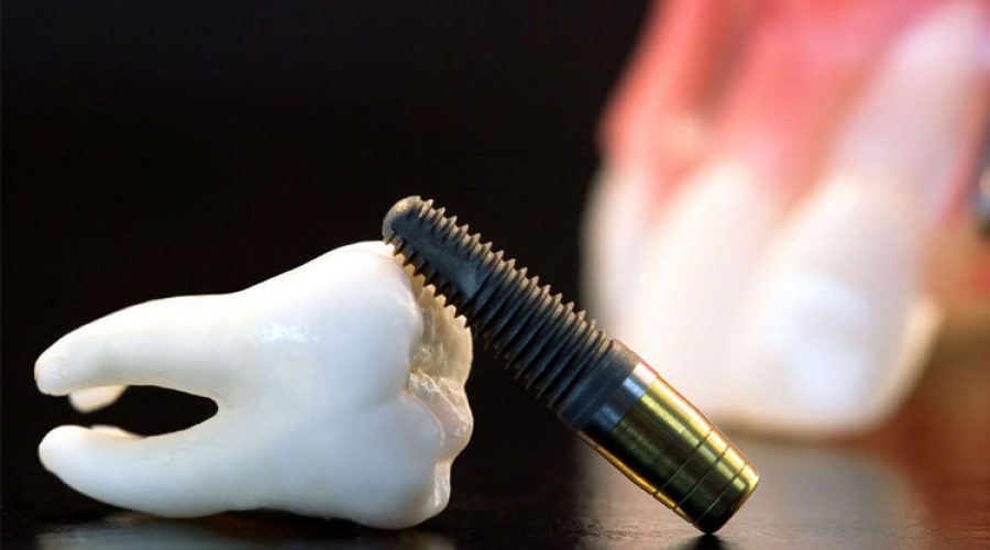 Відторгнення зубних імплантів: симптоми і причини