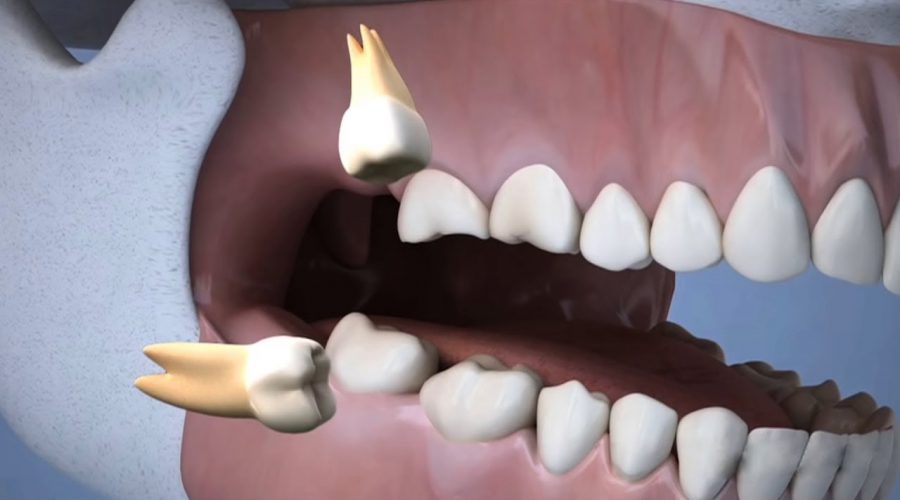 Стоматологи спростували популярні міфи про зуби мудрості