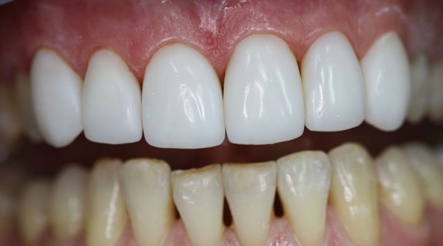 Реставрація зубів