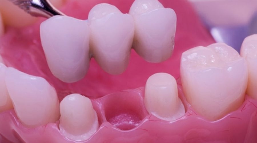 Способи імплантації зубів