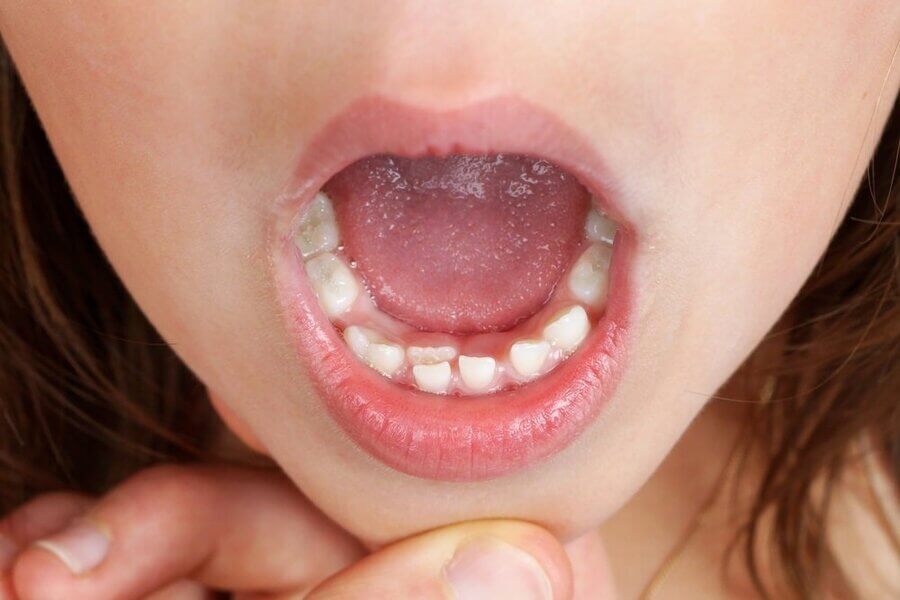 терміни прорізування постійних зубів