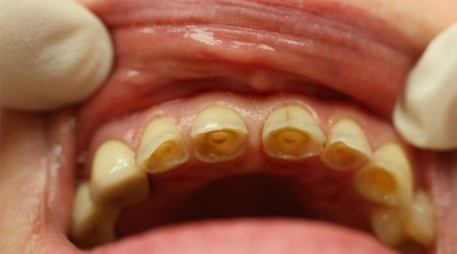 Стертість зубів