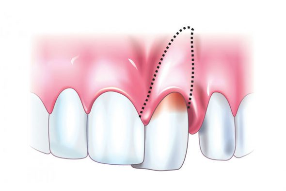 Травмы зубов