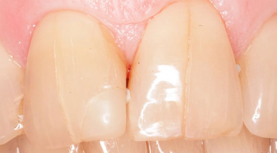 Тріщини в емалі і підвищена чутливість зубів