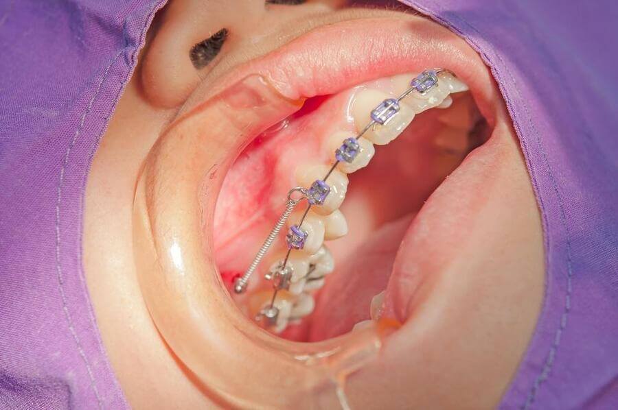 установка ортодонтического имплантата
