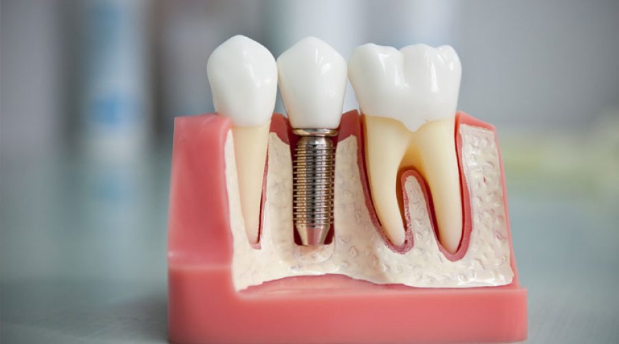 Зубні імпланти за і проти